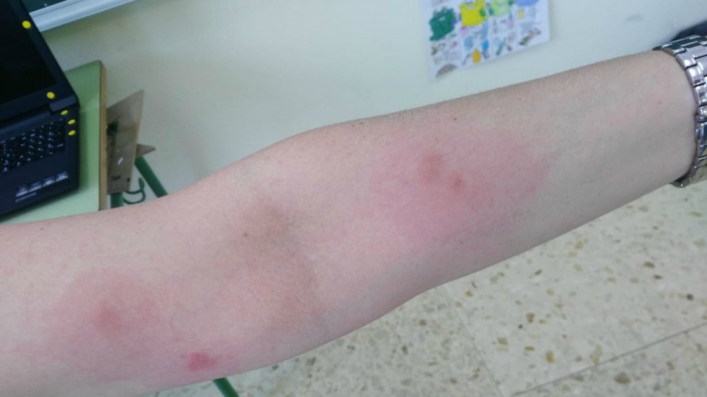 picadura-por-scleroderma-domestica